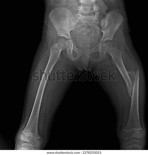 prone bone close up